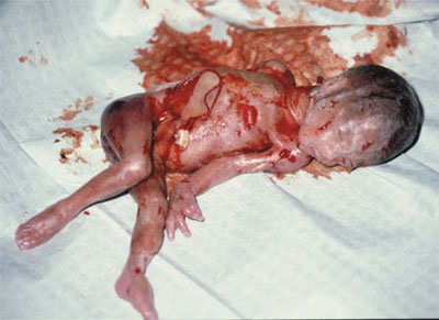 Pictures Aborted Babies on Abortion Photos