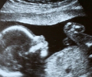 The Power of an Ultrasound-Guided Abortion
