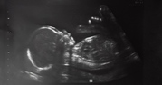 Canada’s top medical journal admits late-term abortions are not rare