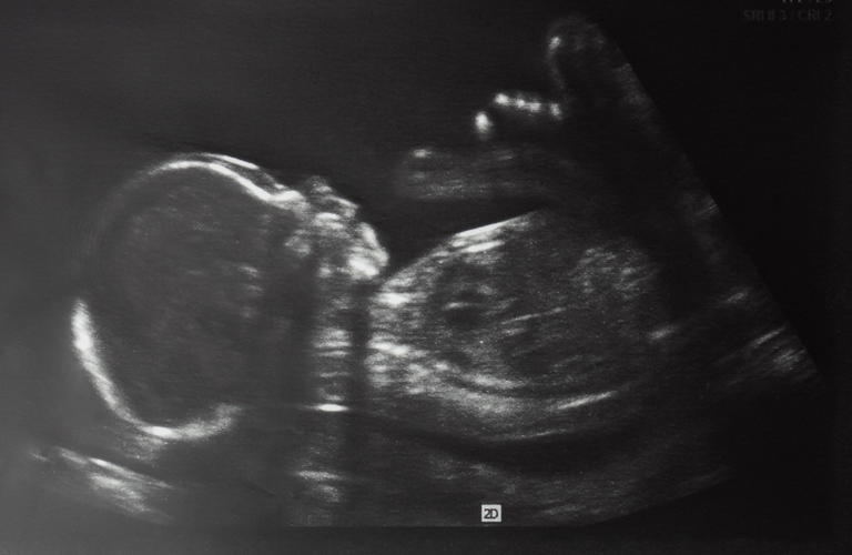 Canada&rsquo;s top medical journal admits late-term abortions are not rare