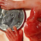 abortion photos