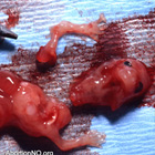 abortion photos