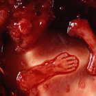 abortion photos