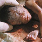 abortion photos